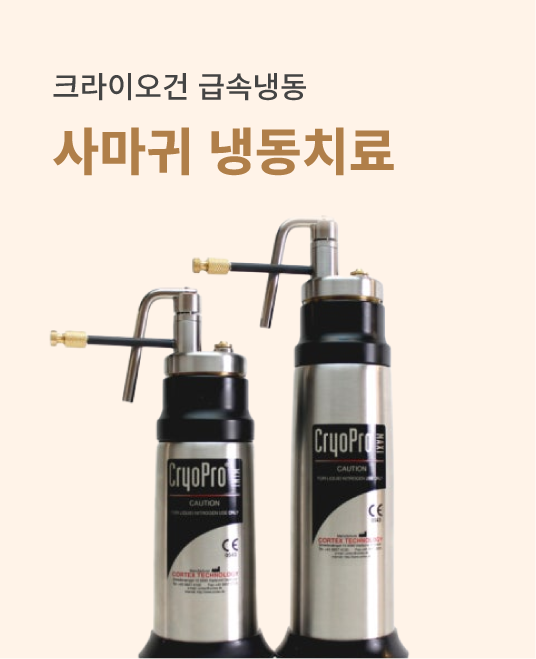 사마귀 냉동치료
